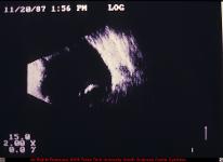 Dislocated Crystalline Lens (B scan)