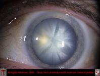 Mature Cataract