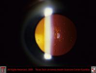 Posterior Subcapsular Cataract Retoillumination