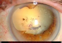 Traumatic Cataract With Extensive Posterior Synechiae