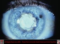 Congenital Cataract