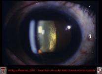 Traumatic Posterior Subcapsular Cataract