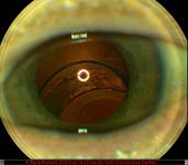 Intraocular Lens Implant Subluxation