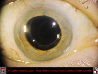 Extracapsular Cataract With Can Opener Capsulotomy