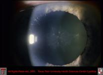 Traumatic Anterior Subcapsular Cataract
