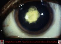 Congenital Cataract