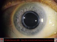 Anterior Capsular Phimosis