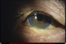 Lower Lid Entropion with Trichiasis