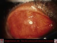 Blepharitis