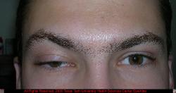 Ptosis OD with Compensatory Brow Elevation