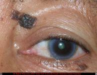 Pigmented Seborrheic Keratosis of Left Upper Lid