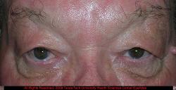 Upper and Lower Lid Dermatochalasis