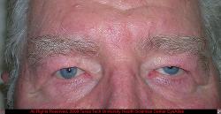 Dermatochalasis OU with Psedoptosis OS