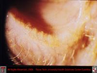 Blepharitis