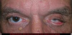 Superior Sulcus Deformity, Ptosis and Lower Lid Ectropion with Phthisis Bulbi OS
