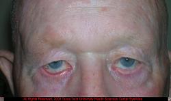 Ectropio and Brow Ptosis