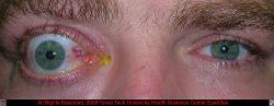 Unilateral Lid Retraction and Exophthalmos Due to Thyroid Eye Disease