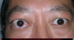 Lid Retraction Due to Grave's Ophthalmopathy