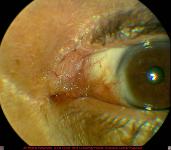 Basal Cell Carcinoma of Caruncle and Medial Upper Lid