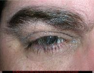 Lash Ptosis Due to Floppy Eyelid Syndrome