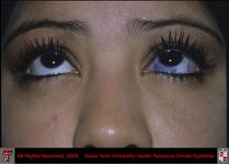 Ocular Melanosis