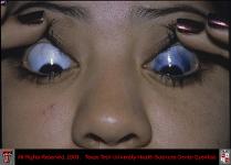 Ocular Melanosis