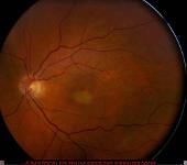 Adult Vitilleform Macular Dystrophy