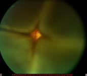 Funnel Retinal Detachment with View of Optic Nerve Head