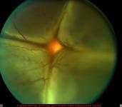 Funnel Retinal Detachment with View of Optic Nerve Head