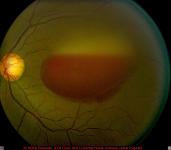 Valsalva Retinopathy with Subhyaloid Hemorrhage