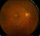 Adult Vitilleform Macular Dystrophy