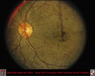 Chorioretinal Scarring Due to Bot Fly Larva