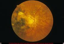Angioid Streaks with Significant Macular Retinal Pigment Epithelial Clumping