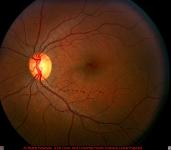 Valsalva Retinopathy with Intraretinal Hemorrhage