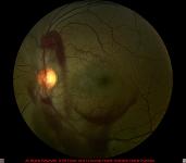 Valsalva Retinopathy with Vitreous Hemorrhage