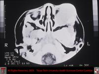 Capillary Hemangioma