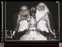 Capillary Hemangioma