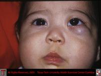 Capillary Hemangioma