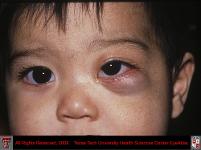 Capillary Hemangioma