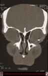 Intraocular Foreign Body