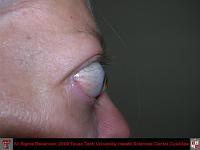 Bilateral Exopthalmos and Lid Retraction Due to Thyroid Eye Disease