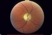 Optic Nerve Pallor After Acute Anterior Ischemic Optic Neuropathy