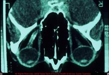 Optic Nerve Sheath Meningioma