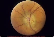 Acute Anterior Ischemic Optic Neuropathy