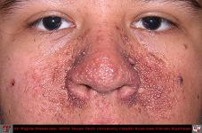 Adenoma Sebaceum Associated with Tuberous Sclerosis