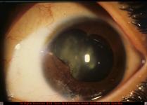 Corneal Laceration