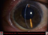 Thermal Corneal Burn After Penetrating Keratoplasty