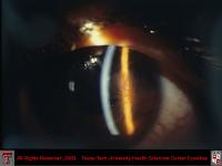 Extensive Corneal Neovascularization