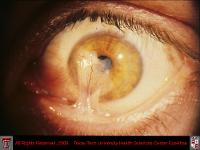 Symblepharon and Corneal Scarring Due to Battery Acid Burn