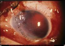 Corneal Laceration